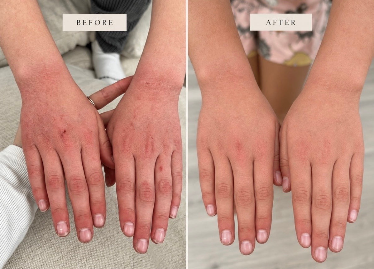 SENSITIVE SKIN